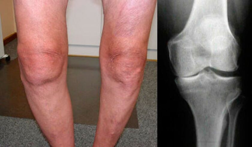 οστεοαρθρίτιδα της άρθρωσης του γόνατος